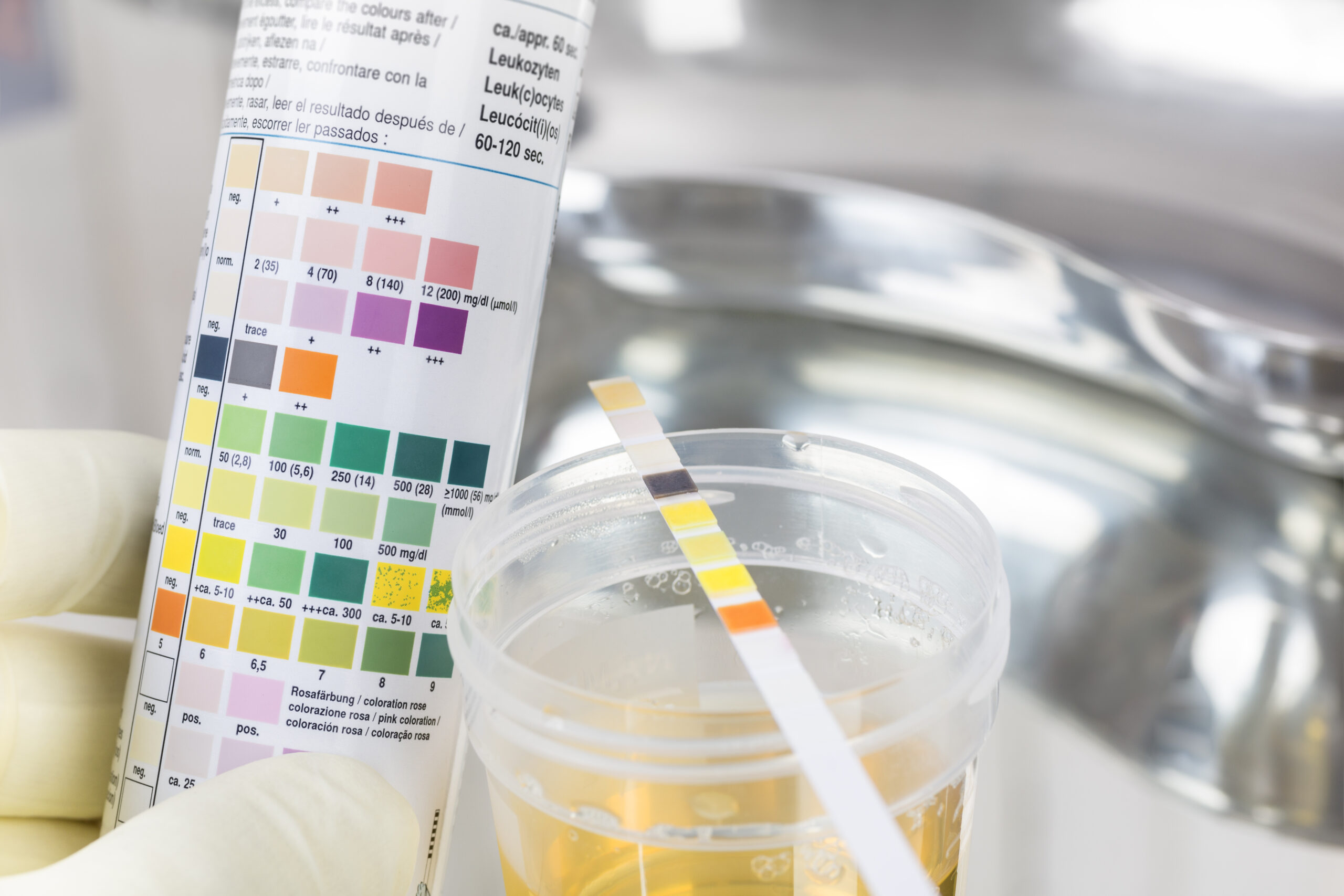 Routine test, urine rapid test, urine test strip, urine sample
